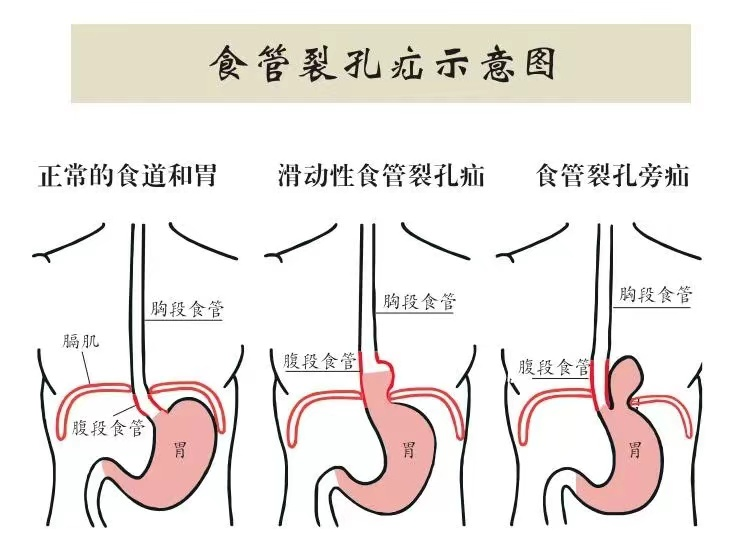 渠县人民医院成功开展腹腔镜…